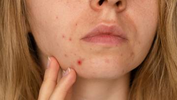 Masz te objawy? Mogą świadczyć o pasożytach w organizmie